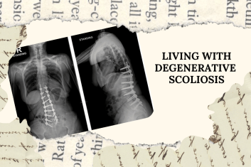 Living with Degenerative Scoliosis: Mrs. X’s Story