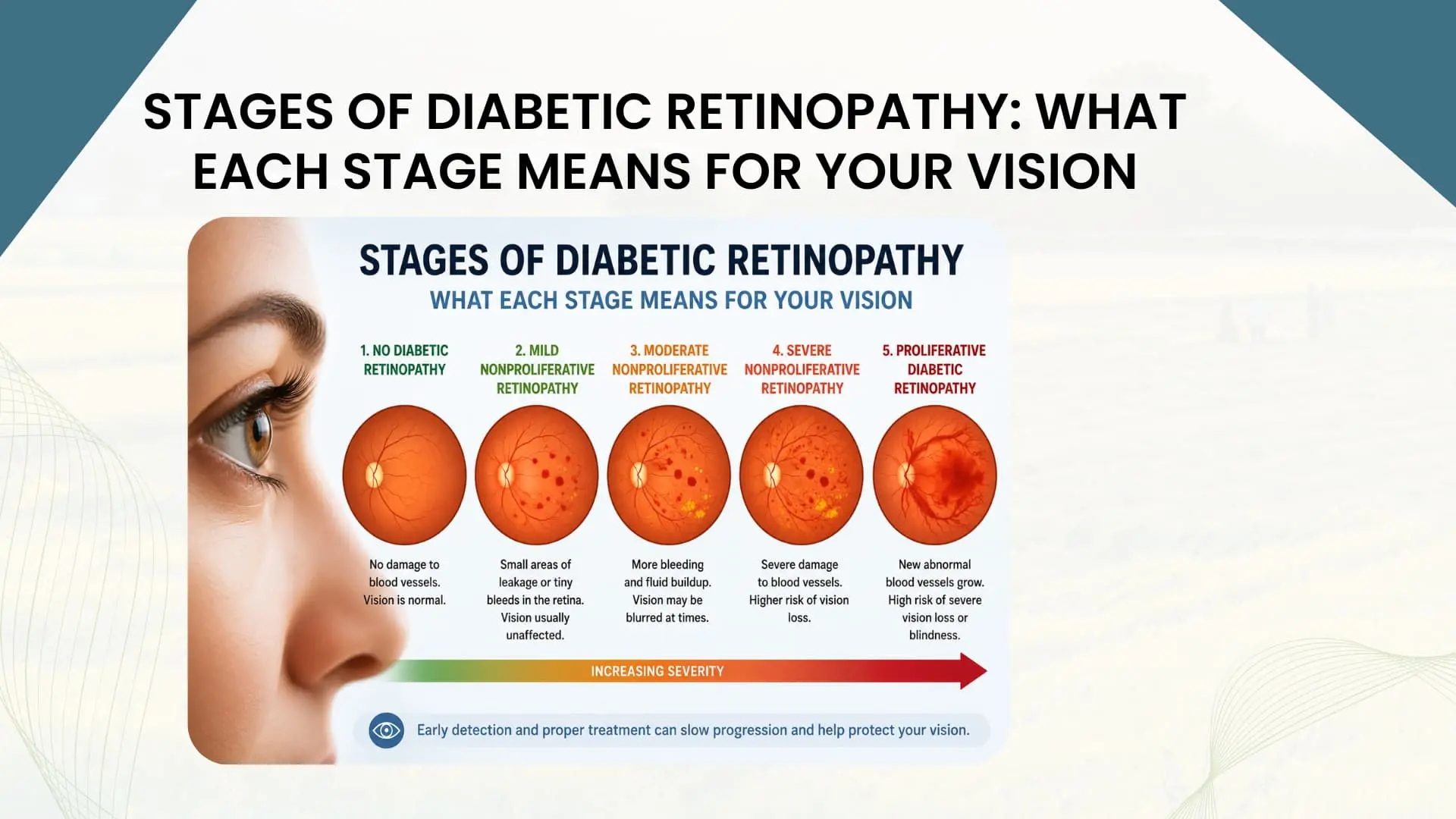 Stages of Diabetic Retinopathy: What Each Stage Means for Your Vision