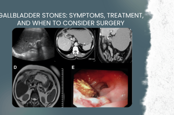 Gallbladder Stones: Symptoms, Treatment, and When to Consider Surgery – A Guide by Dr. Moksha Gowda