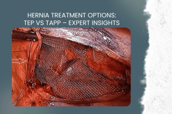 Hernia Treatment Options: TEP vs TAPP – Expert Insights by Dr. Moksha Gowda