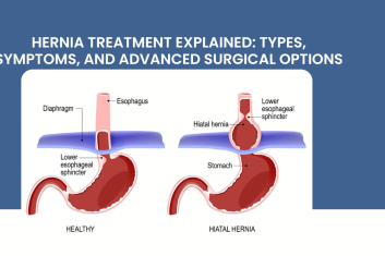 Hernia Treatment Explained: Types, Symptoms, and Advanced Surgical Options