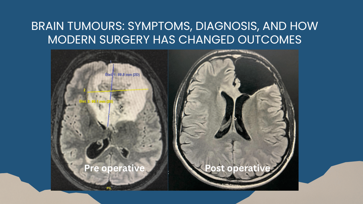 Brain Tumours: Symptoms, Diagnosis, and How Modern Surgery Has Changed Outcomes 