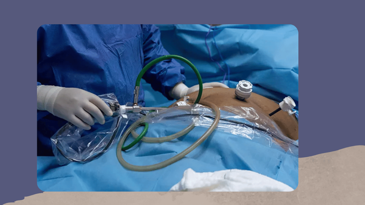 advanced laparoscopic gi surgery complete guide mysuru