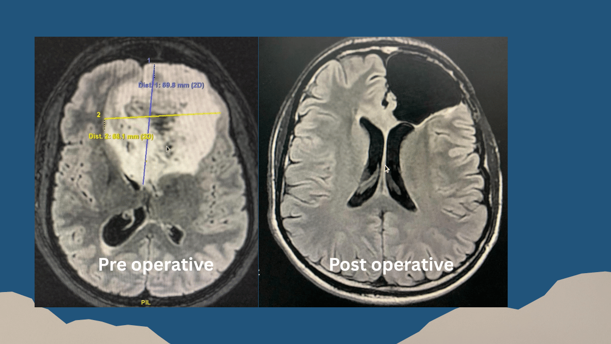 brain tumour symptoms treatment perumbakkam chennai