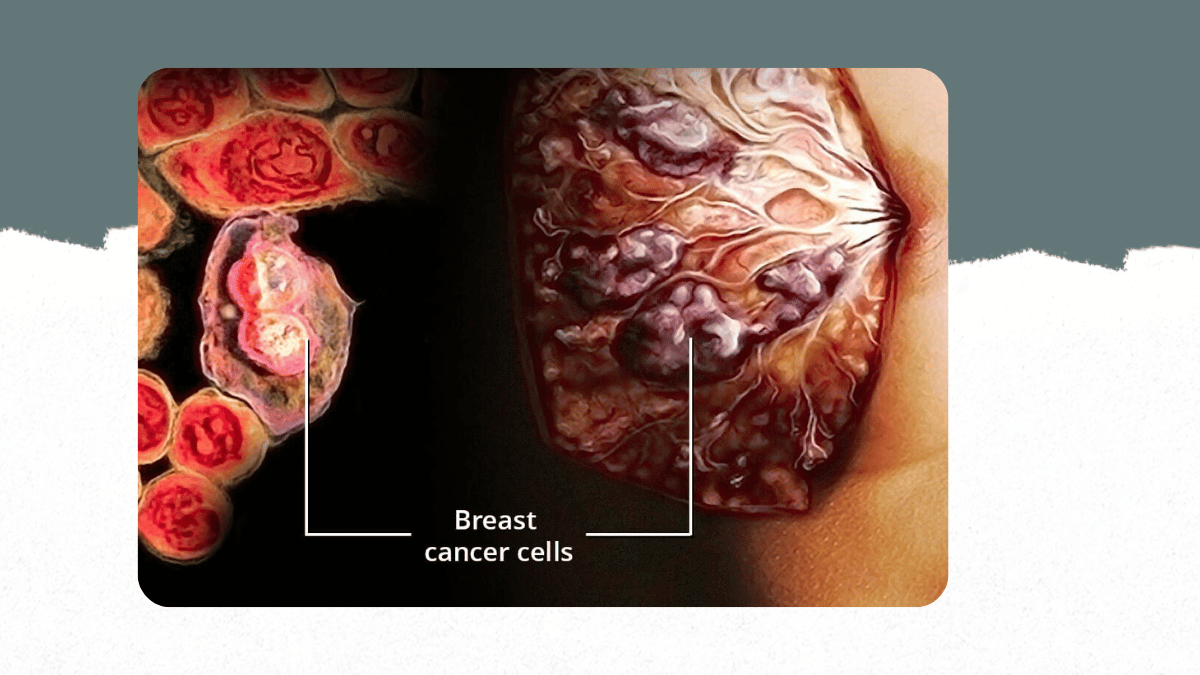 https://d2vvc091k8tmib.cloudfront.net/s3fs-public/2026-07/Curing%20Metastatic%20Cancer%20in%20the%20Modern%20Era%20The%20Phenomenon%20Named%20Oligometastatic%20Breast%20Cancer%20%281%29.png