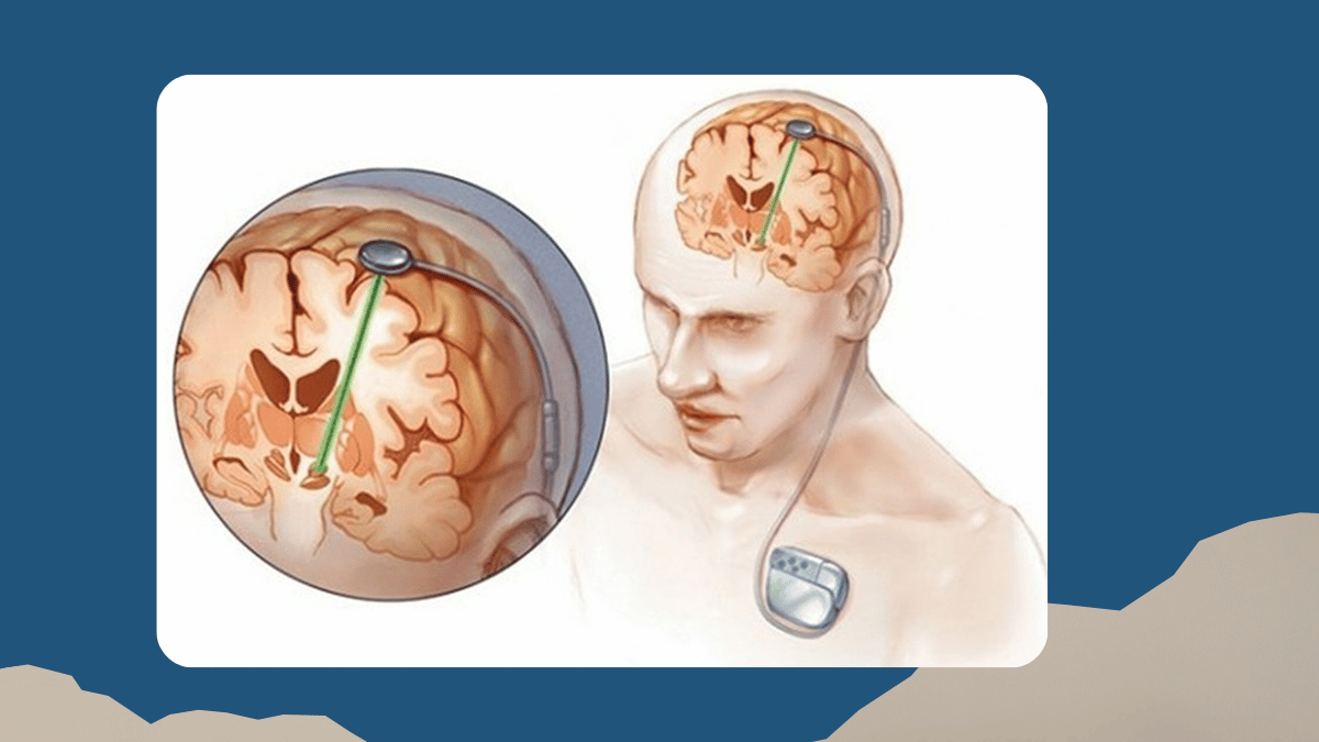 https://d2vvc091k8tmib.cloudfront.net/s3fs-public/2026-07/Deep%20Brain%20Stimulation.png
