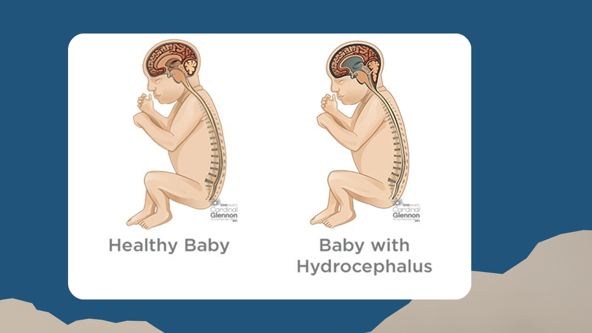 https://d2vvc091k8tmib.cloudfront.net/s3fs-public/2026-07/Hydrocephalus%20in%20Newborns.png