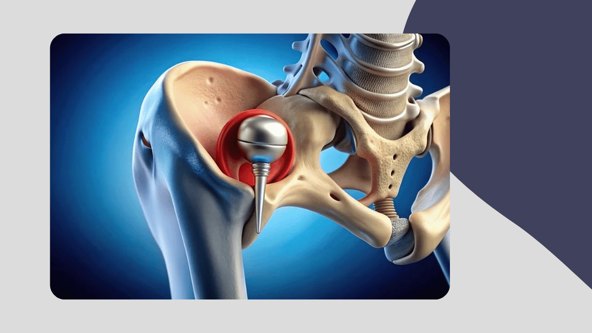 robotic hip replacement precision faster recovery mobility