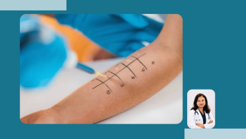 Allergy Skin Prick Test