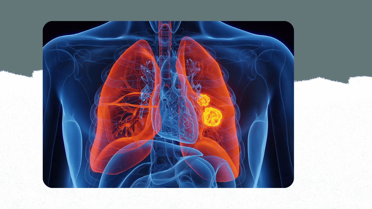 https://d2vvc091k8tmib.cloudfront.net/s3fs-public/2026-08/Curing%20Metastatic%20Cancer%20in%20the%20Modern%20Era.png