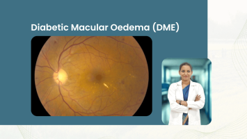 Diabetic Macular Oedema (DME): Diagnosis and Treatment
