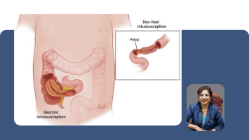 Intussusception and Paediatric Abdominal Emergencies