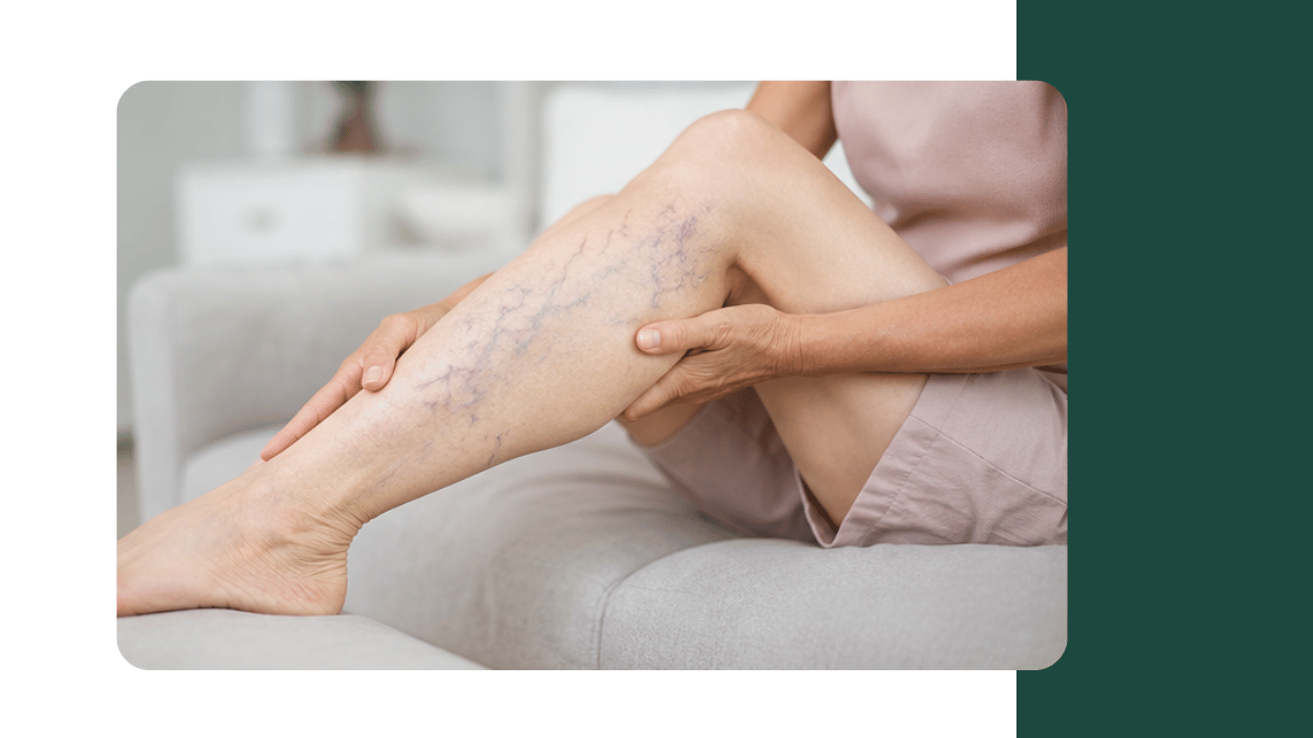varicose veins symptoms treatment options bengaluru
