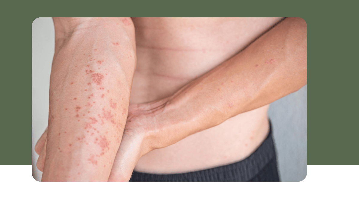 https://d2vvc091k8tmib.cloudfront.net/s3fs-public/2026-09/Atopic%20Dermatitis%20in%20Chennai.png