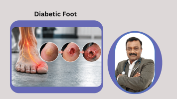 Diabetic Foot: How Neuropathy Leads to Ulcers and How to Interrupt the Chain