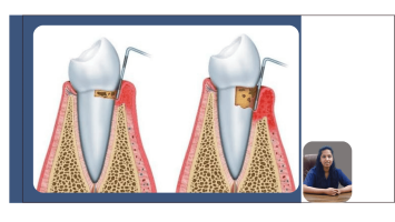 Gingivitis and Periodontitis: Understanding Gum Disease Before It Progresses