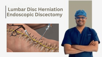  Lumbar Disc Herniation Endoscopic Discectomy