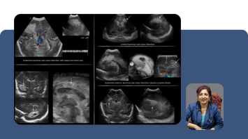 Neonatal Cranial POCUS and Intraventricular Haemorrhage: Protecting the Premature Brain at the Bedside