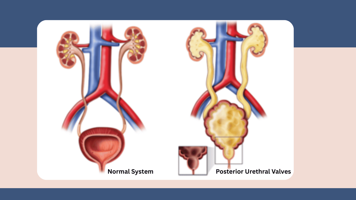https://d2vvc091k8tmib.cloudfront.net/s3fs-public/2026-09/Posterior%20Urethral%20Valves%20in%20Male%20Newborns.png