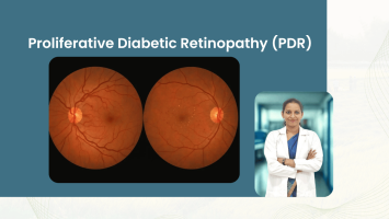 Proliferative Diabetic Retinopathy (PDR): Laser and Vitrectomy