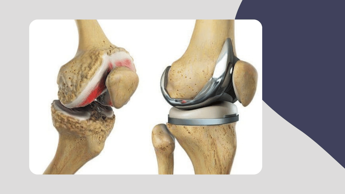 https://d2vvc091k8tmib.cloudfront.net/s3fs-public/2026-09/Revision%20Joint%20Replacement%20Surgery%20What%20It%20Is%2C%20Why%20It%20Is%20Needed%2C%20and%20What%20Patients%20Should%20Know.png