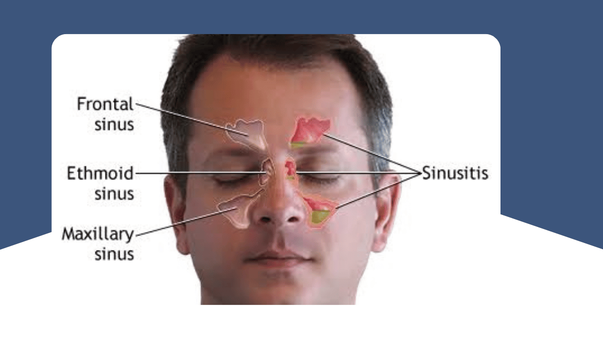 https://d2vvc091k8tmib.cloudfront.net/s3fs-public/2026-09/Sinus%20Disorders%20and%20FESS.png