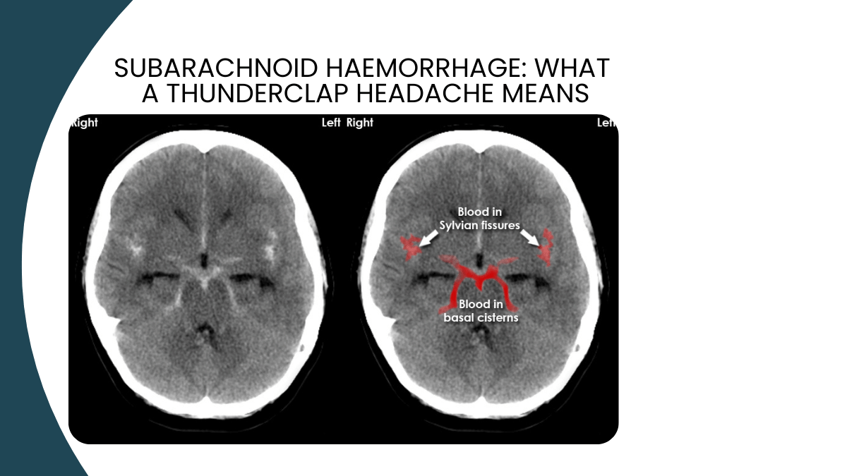 subarachnoid haemorrhage thunderclap headache emergency bengaluru