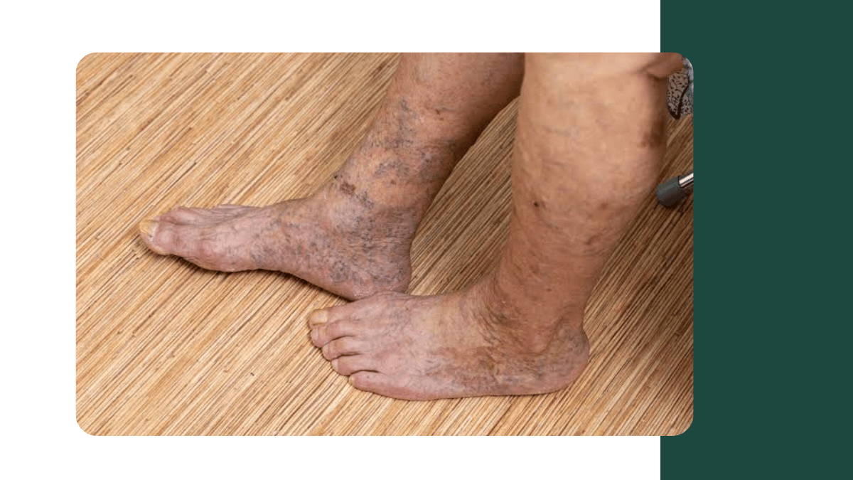 vascular disease symptoms complete guide vascular surgeon bengaluru
