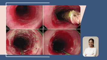 Endoscopic Valve Ablation and Long-Term Follow-Up: The Surgery and What Comes After