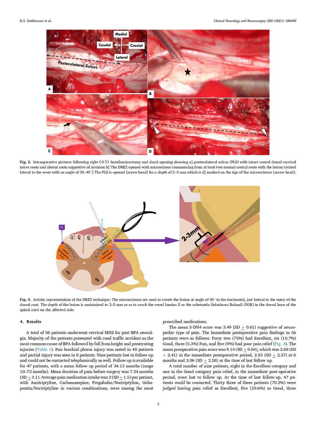Dr. Ramesh Doddamani - Microscissor DREZotomy for Post-Brachial Plexus ...