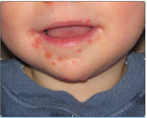 enteroviruses